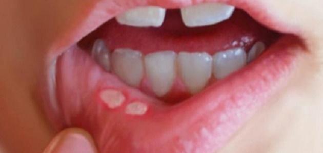 فطريات الفم عند الأطفال